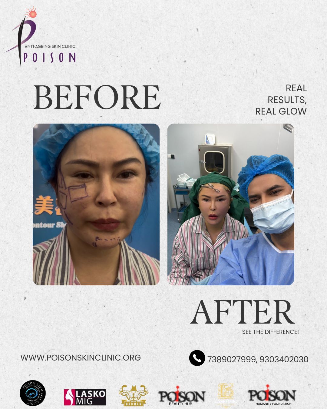 Neuromodulation (Botox)