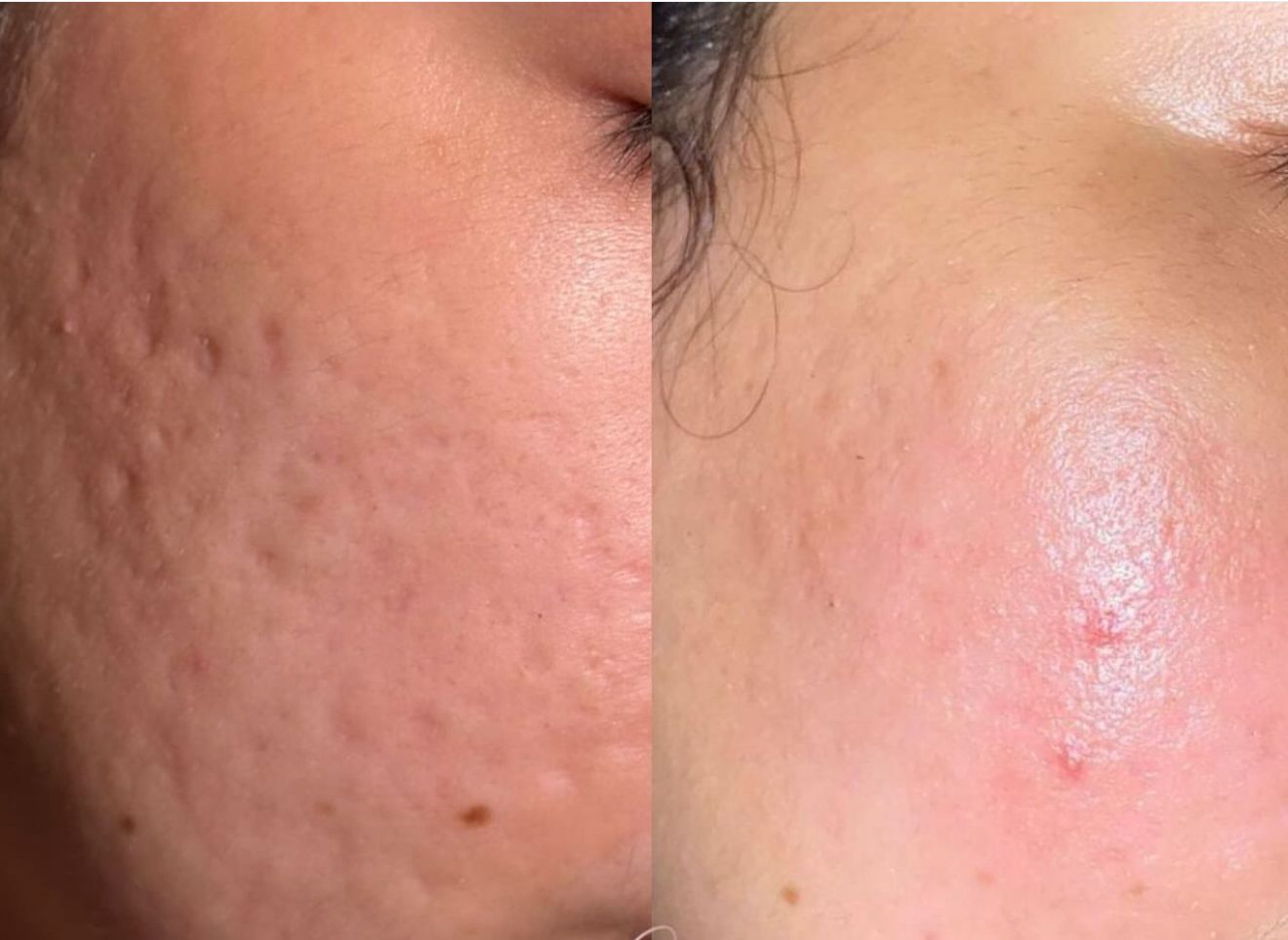 Endolaser Contouring